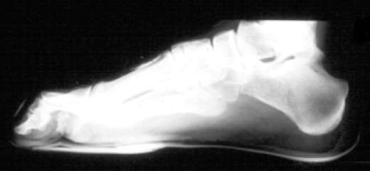 How Should Climbing Shoes Fit - X Ray Foot